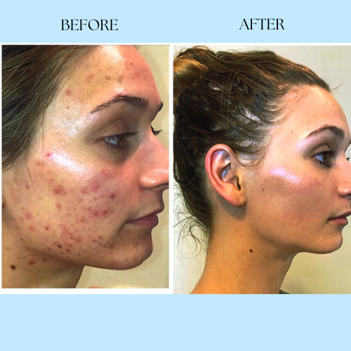 Clarora Hormonal Acne Supplement