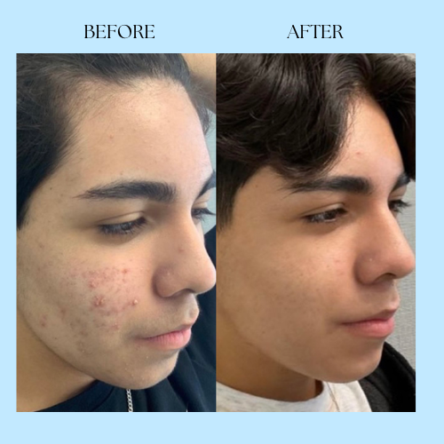 Clarora Hormonal Acne Supplement
