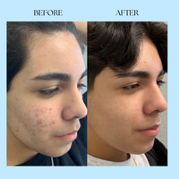 Clarora Hormonal Acne Supplement